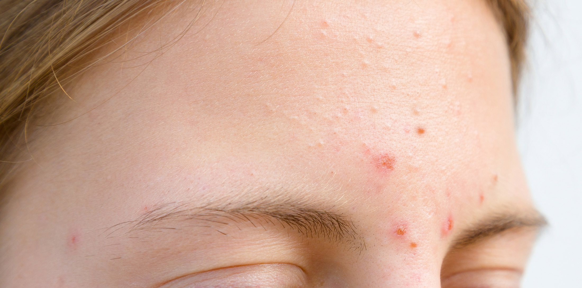 acne scars condition