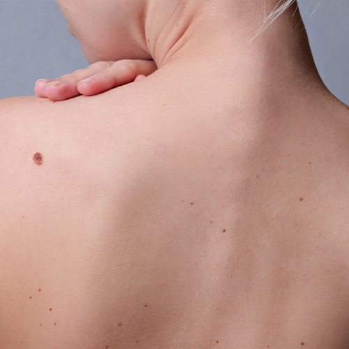 skin condition moles 1 SKIN Clinics