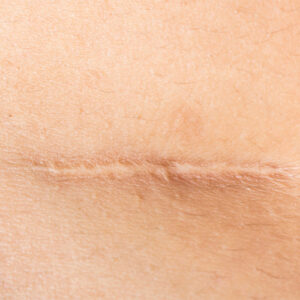 Scar Revision - SKIN Clinics