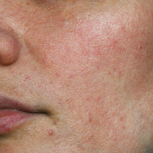 Uneven Skin Texture - SKIN Clinics