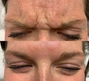 Botox Injection in the Forehead. Botox Cosmetic Before and After. Botox Treatment In Regina