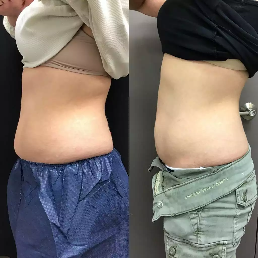 COOLSCULPTING 1 SKIN Clinics