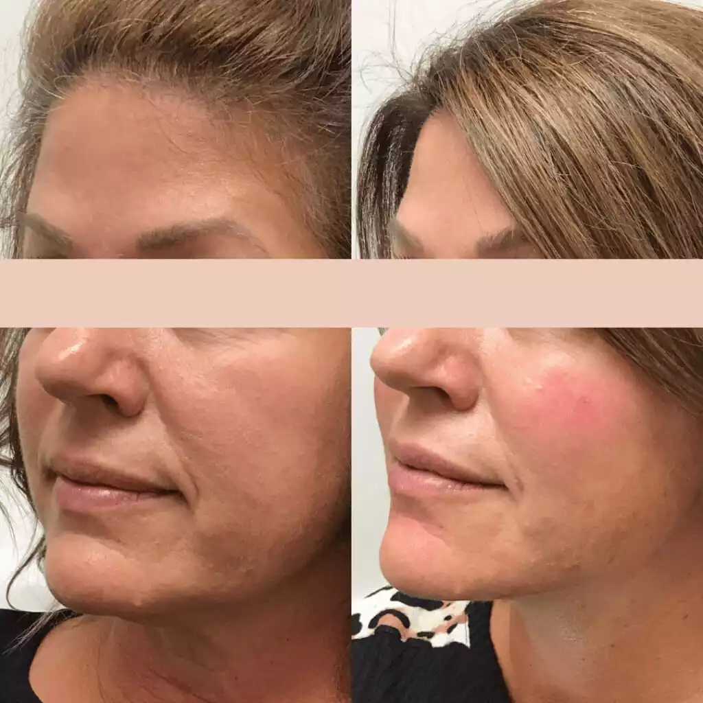 Before & After 14 Temple Cheek and Jawline Filler SKIN Clinics