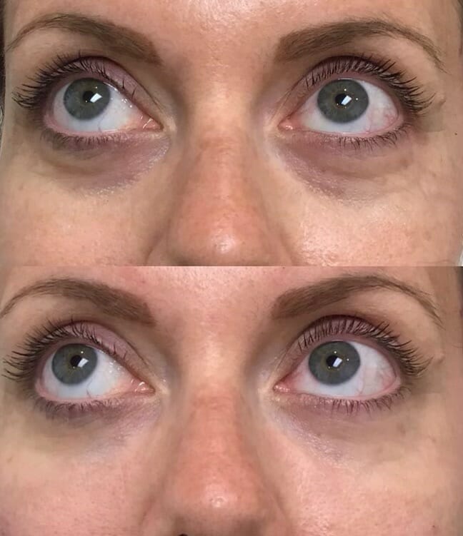 Under-Eye-Filler