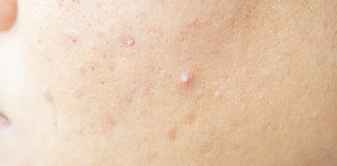 acne scars condition