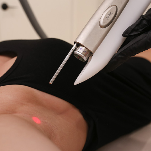 laser hair removal by SKIN Clinics