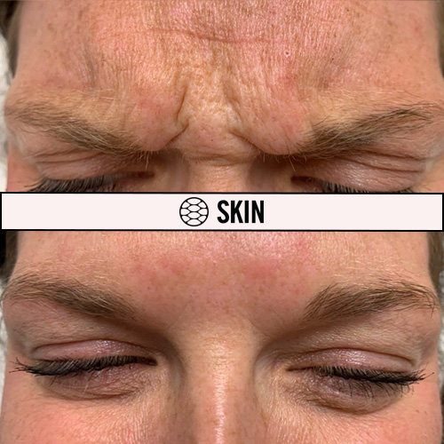 Botox Forehead treatment 11 SKIN Clinics