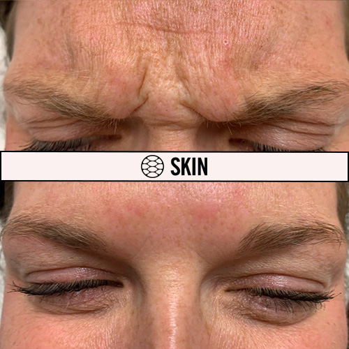 Botox Injection in the Forehead. Botox Cosmetic Before and After. Botox Treatment In Regina