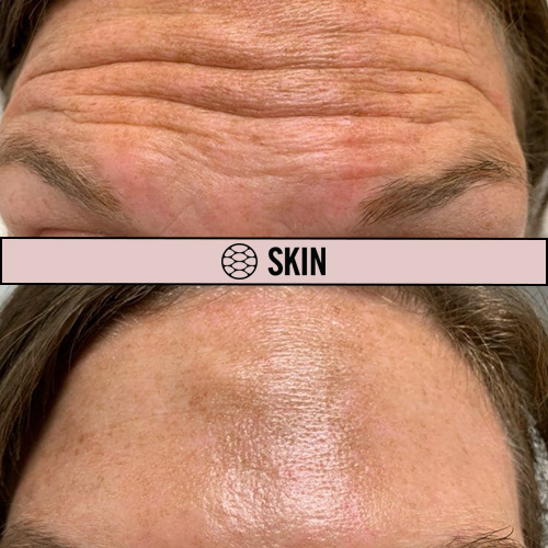 Botox Injection in the Forehead. Botox Cosmetic Before and After. Botox Treatment In Regina