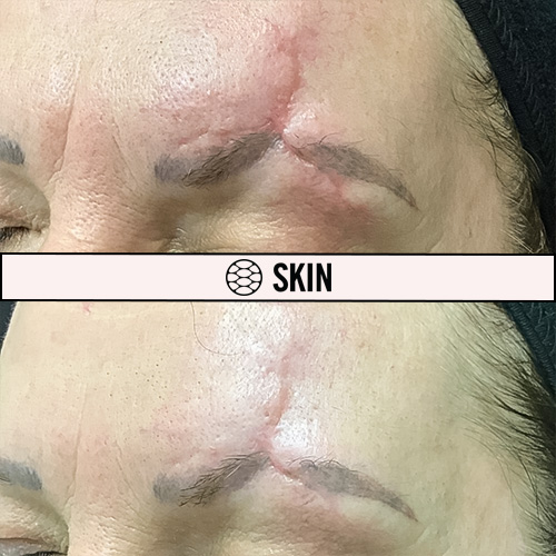 Deep Fractionated Resurfacing before and after 1 SKIN Clinics