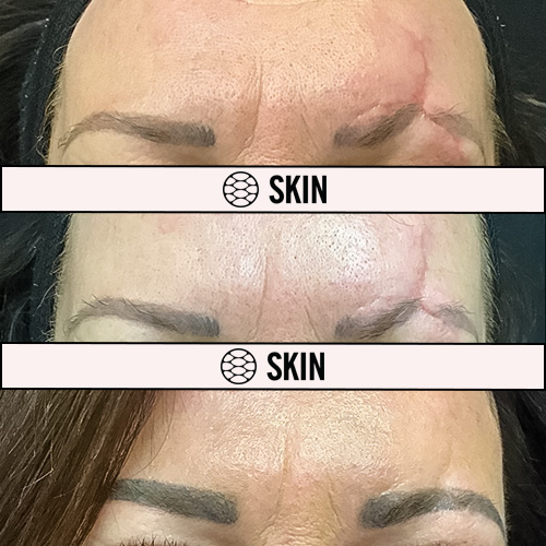 Deep Fractionated Resurfacing before and after 2 SKIN Clinics