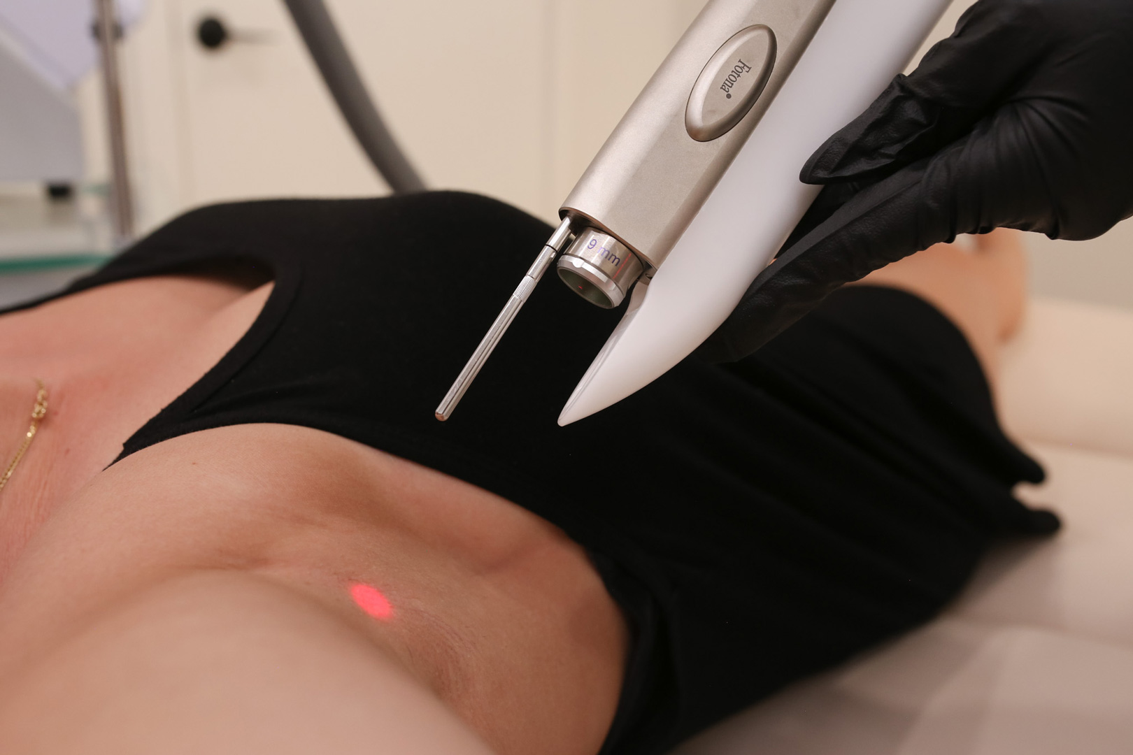 Laser hair removal in Calgary