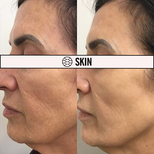 Photofractional before and after 3 SKIN Clinics