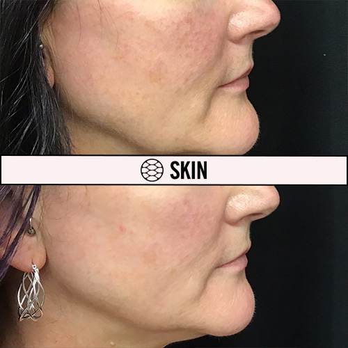 Photofractional before and after SKIN Clinics