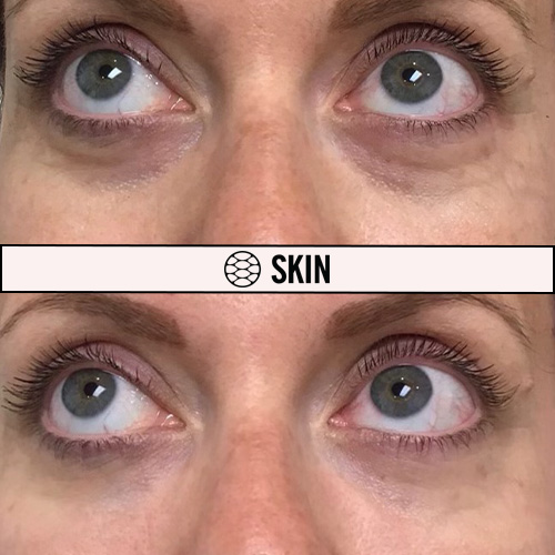 Under Eye Filler before and after 1 SKIN Clinics