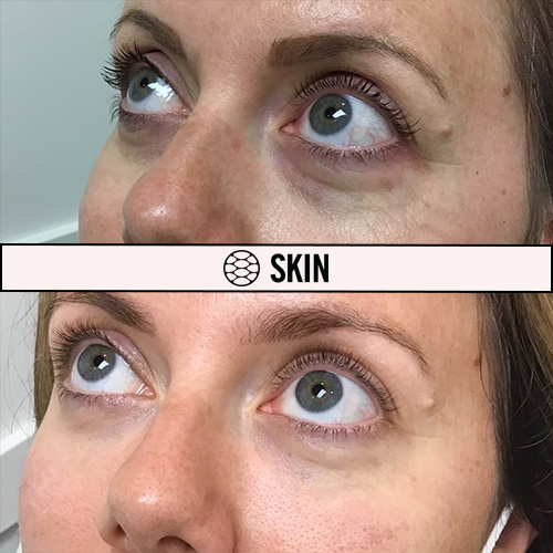 Under Eye Filler before and after SKIN Clinics
