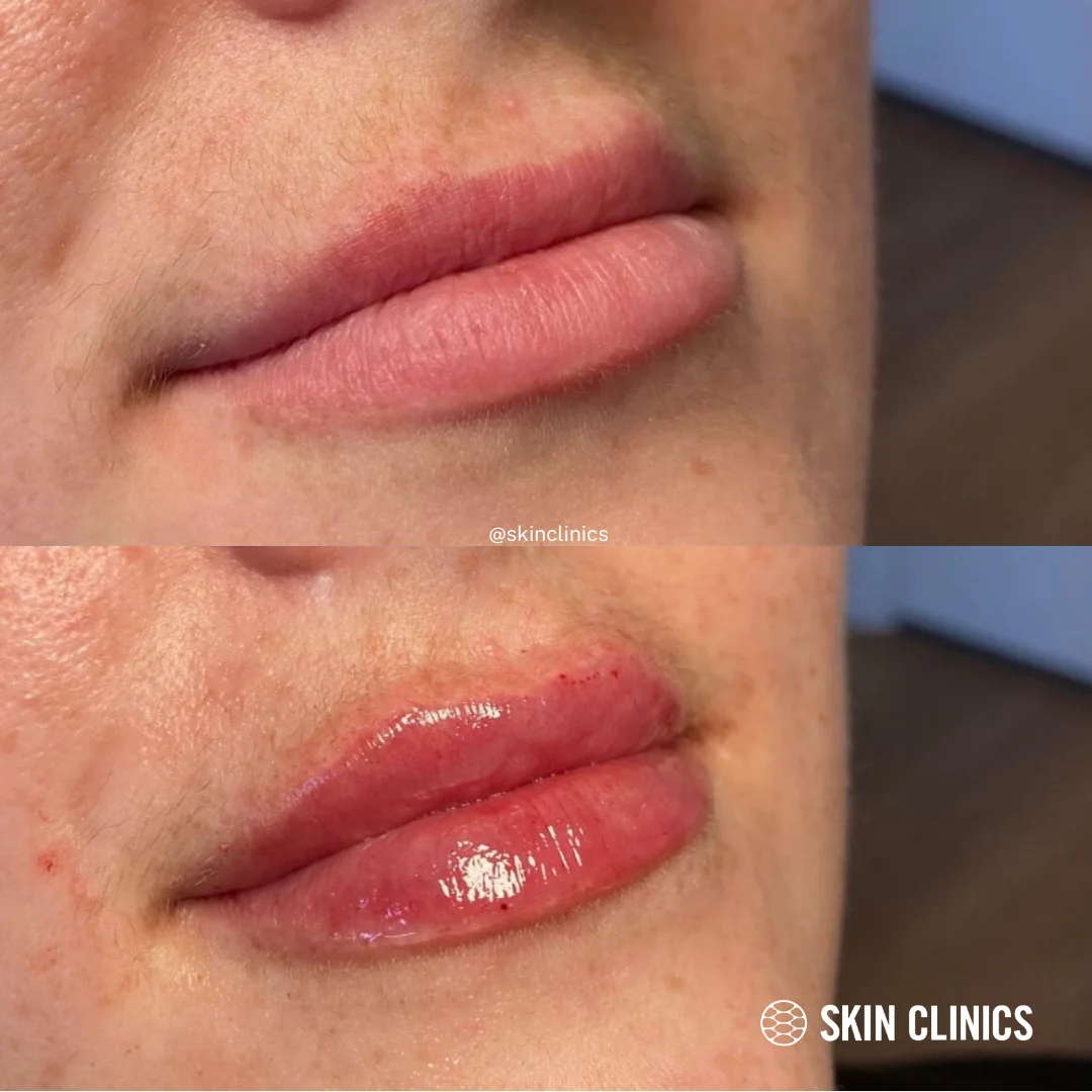 lip fillers in calgary 1 SKIN Clinics