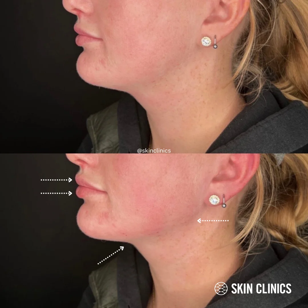 lip fillers in calgary 3 SKIN Clinics