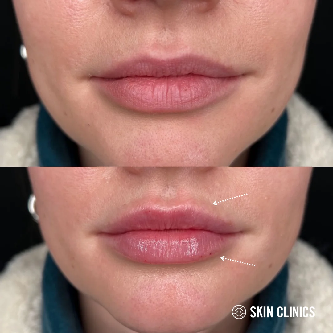 lip fillers in calgary 5 SKIN Clinics