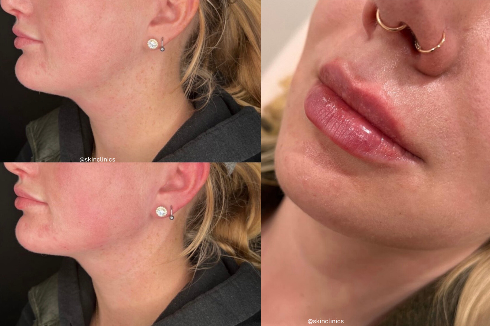 Lip Fillers in Calgary 2 lip fillers in calgary AB SKIN Clinics