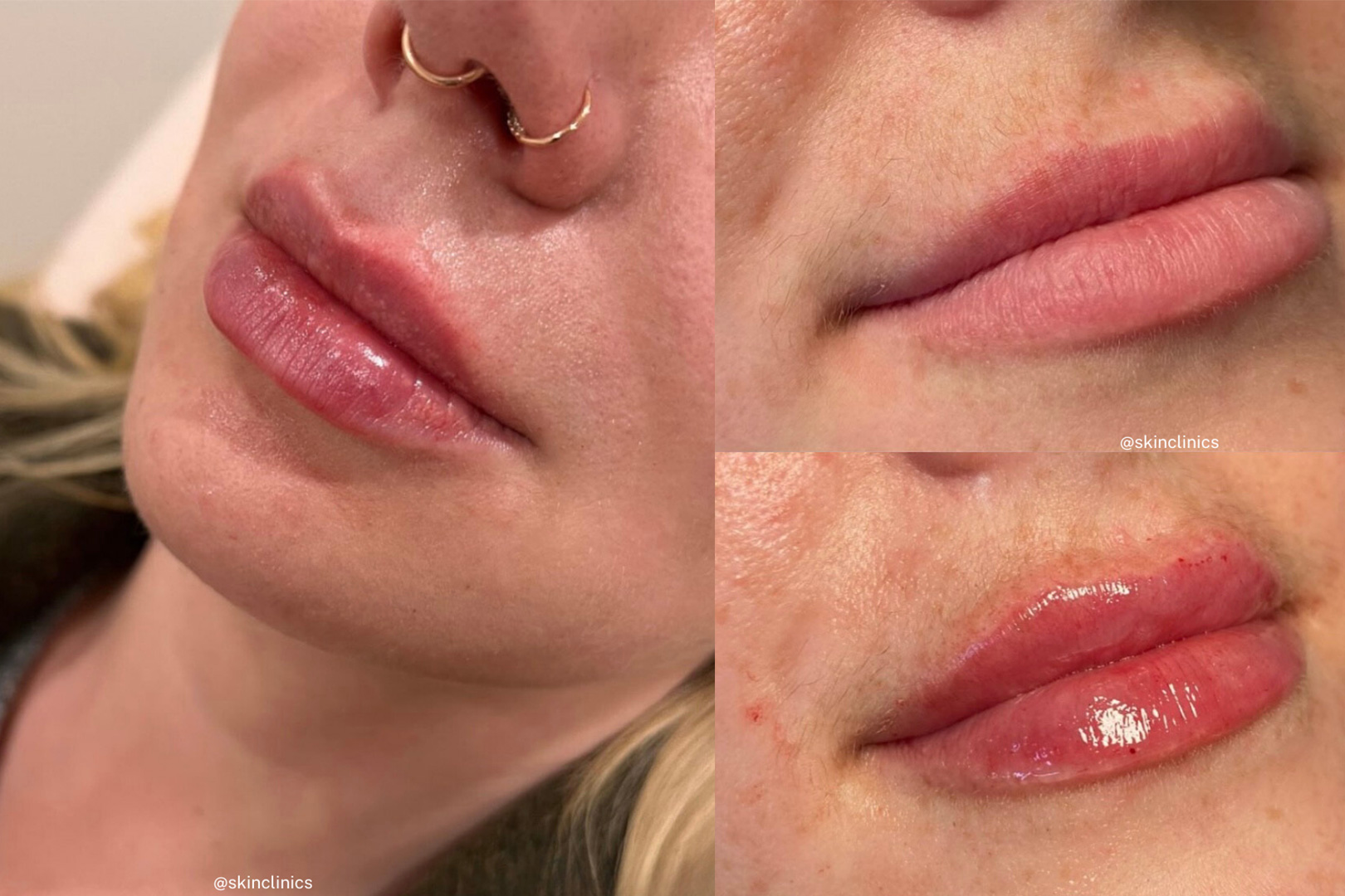 lip fillers in calgary SKIN Clinics