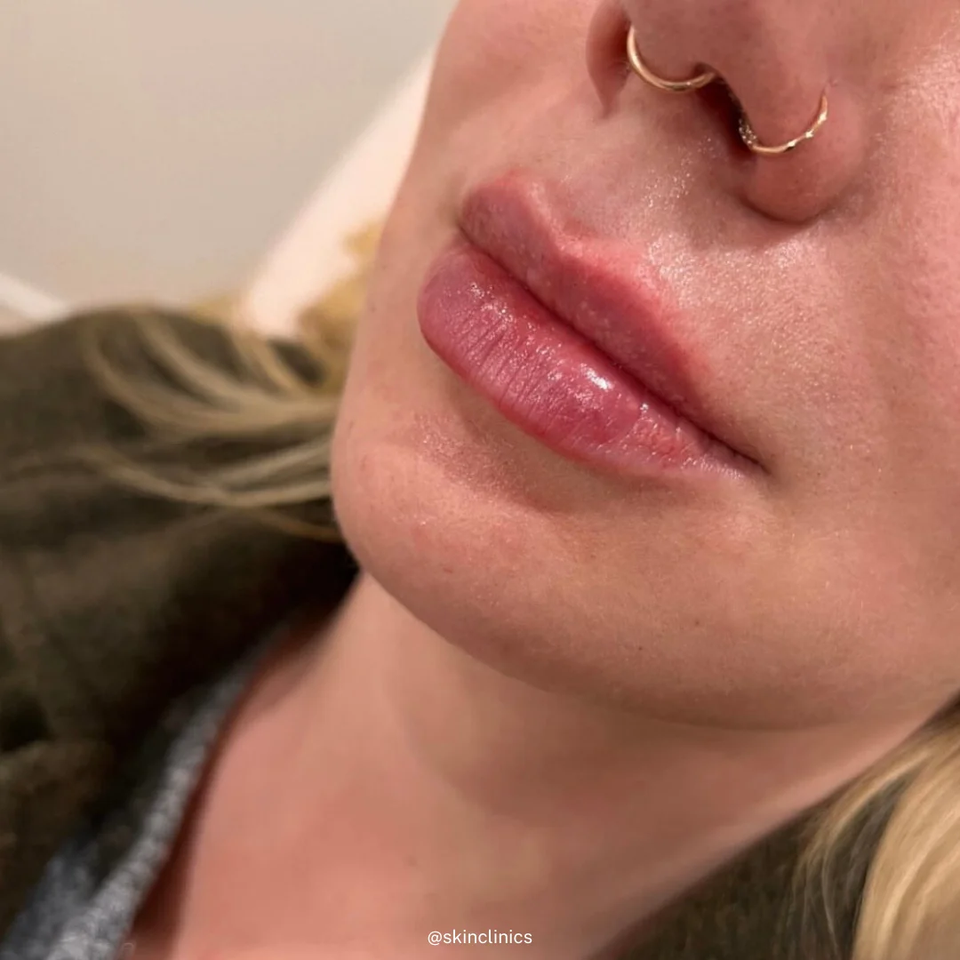 lip fillers in calgary SKIN Clinics