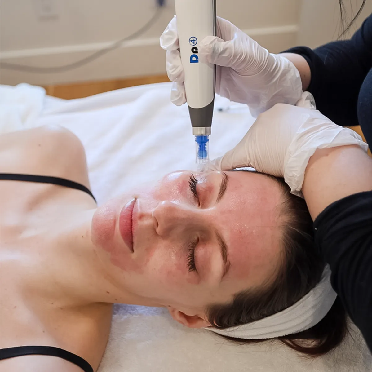 Rediscover Radiant Skin with Microneedling at SKIN Clinics Winnipeg