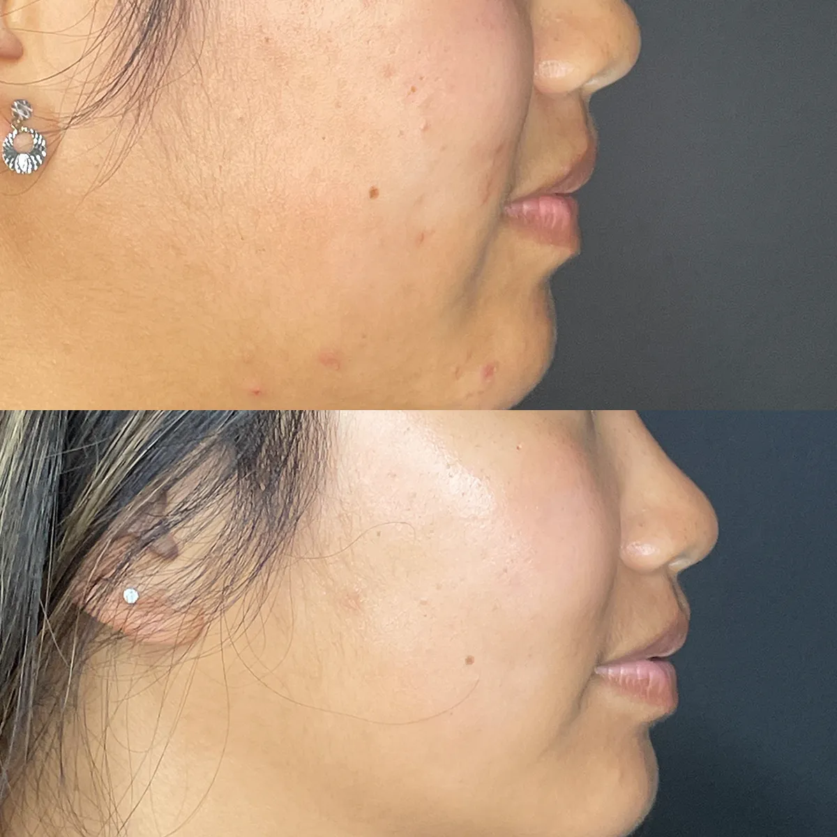 Oxygeneo Facial before n After 1 SKIN Clinics