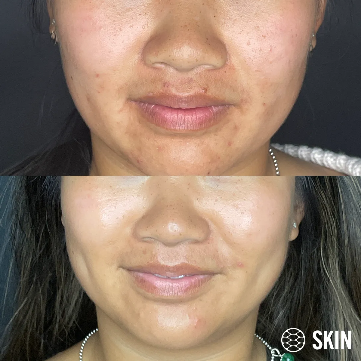 Oxygeneo Facial before n After 2 SKIN Clinics