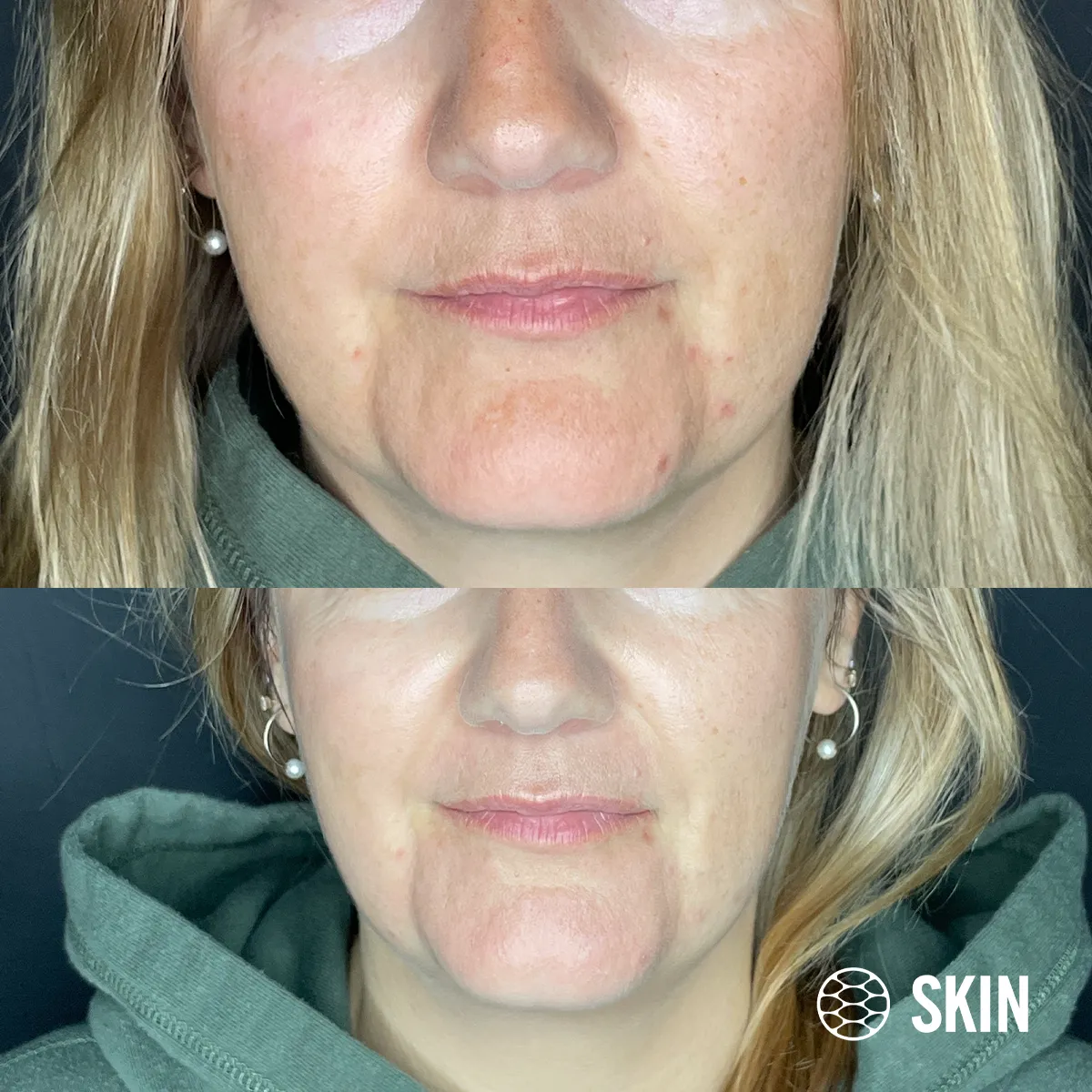 Oxygeneo Facial before n After 3 SKIN Clinics