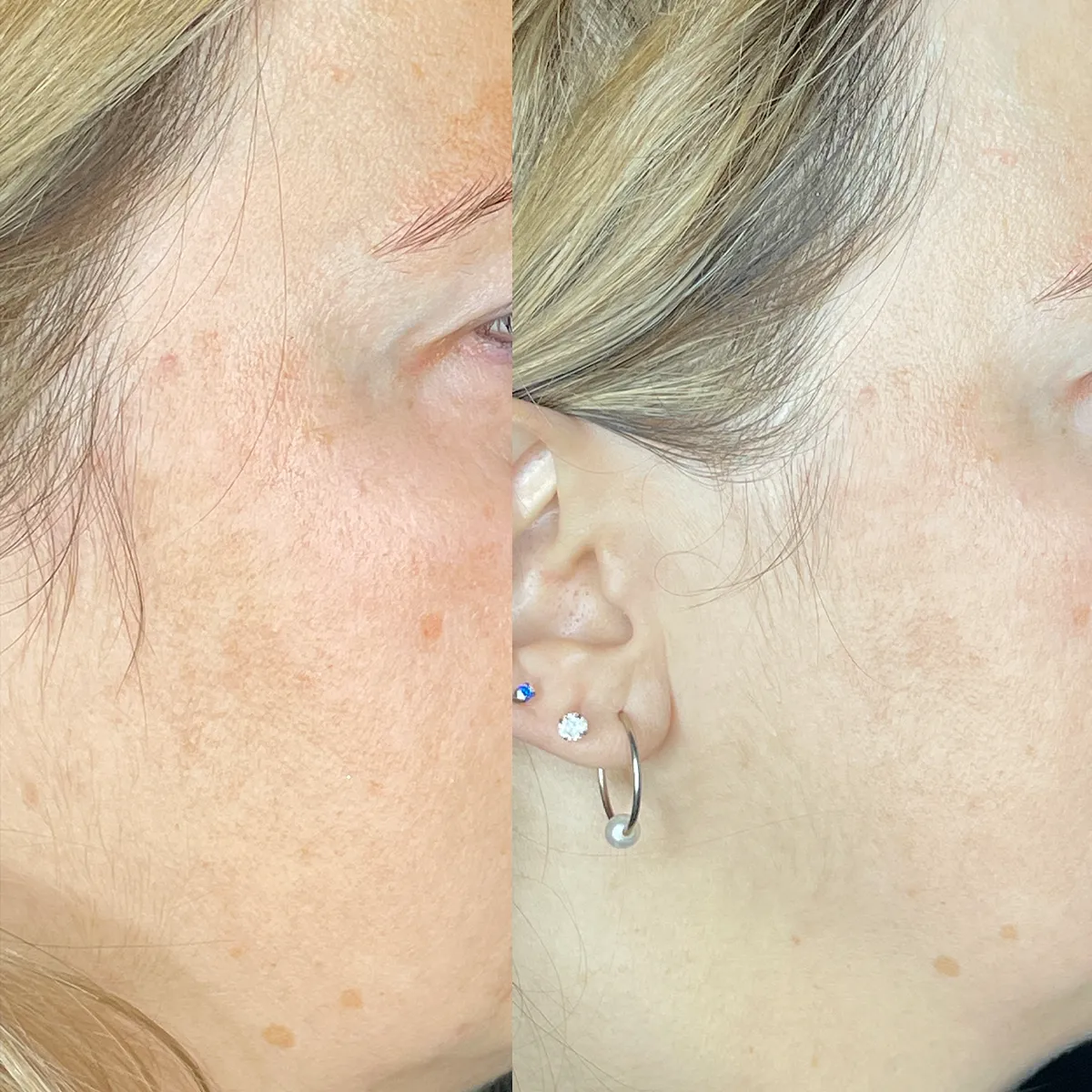 Oxygeneo Facial before n After 4 SKIN Clinics