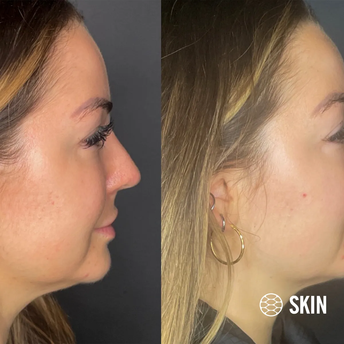 Oxygeneo Facial before n After 5 SKIN Clinics