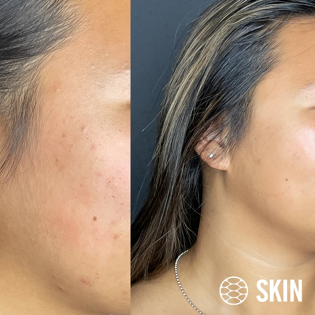 Oxygeneo Facial before n After SKIN Clinics
