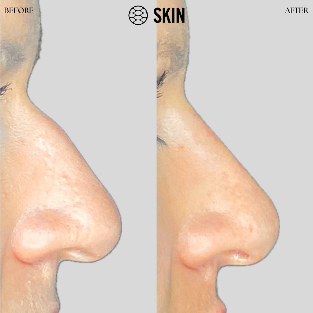 Non Surgical Rhinoplasty 1 SKIN Clinics