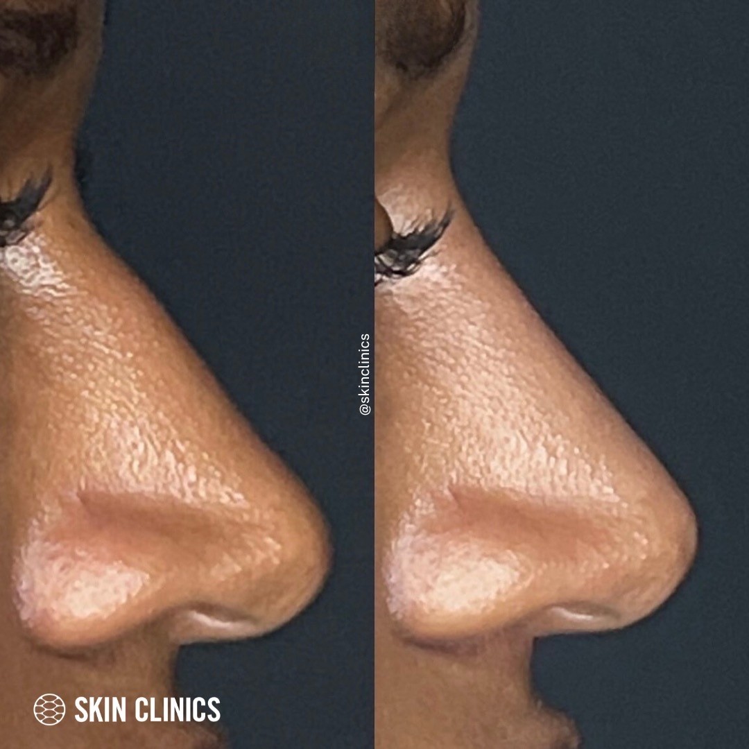 Non Surgical Rhinoplasty 2 SKIN Clinics