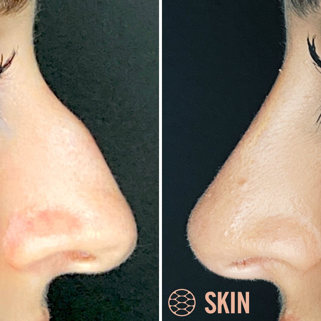 Non Surgical Rhinoplasty 4 SKIN Clinics