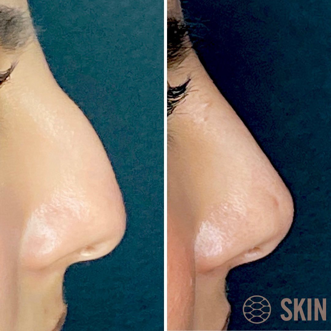 Non Surgical Rhinoplasty 5 SKIN Clinics