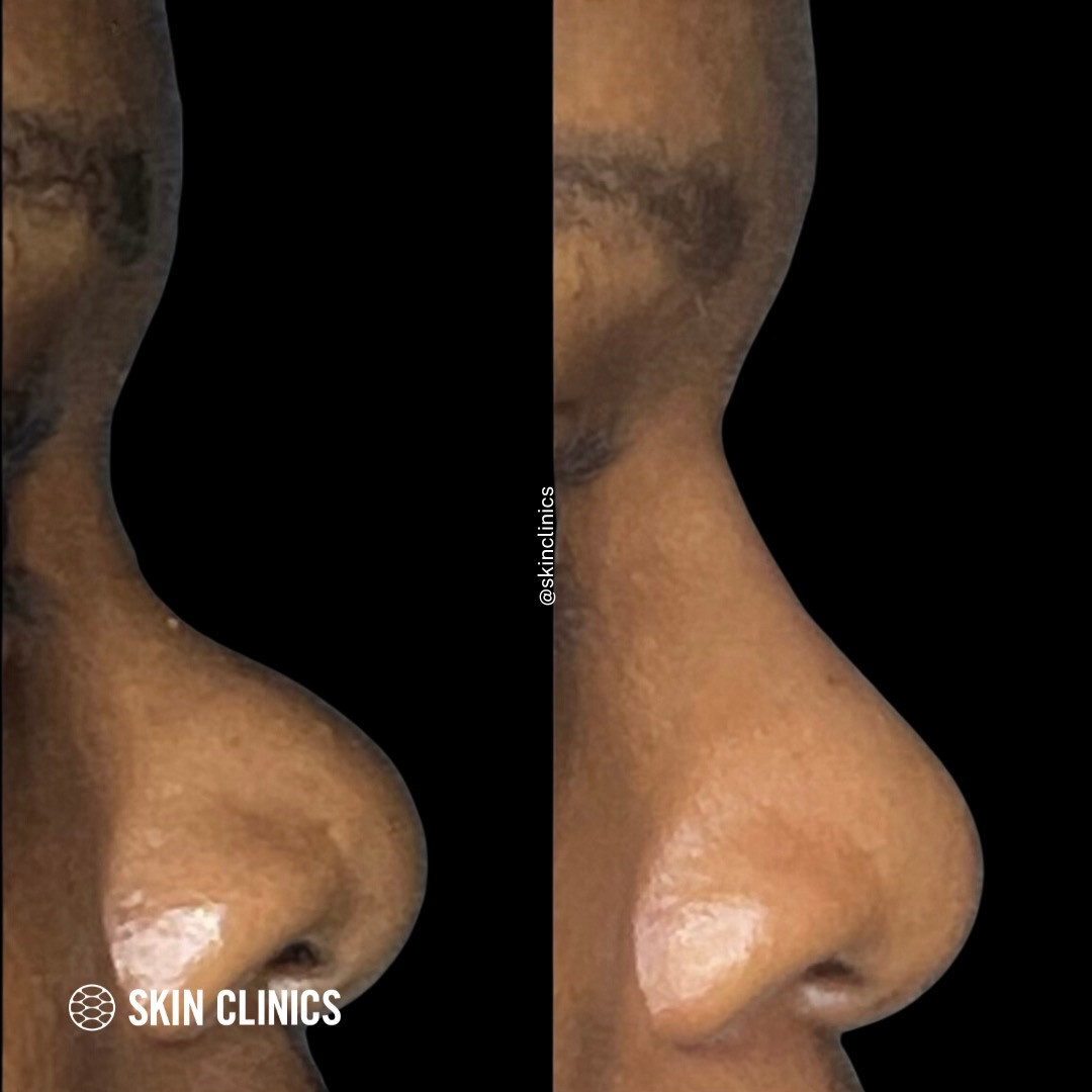 Non Surgical Rhinoplasty calgary 1 SKIN Clinics