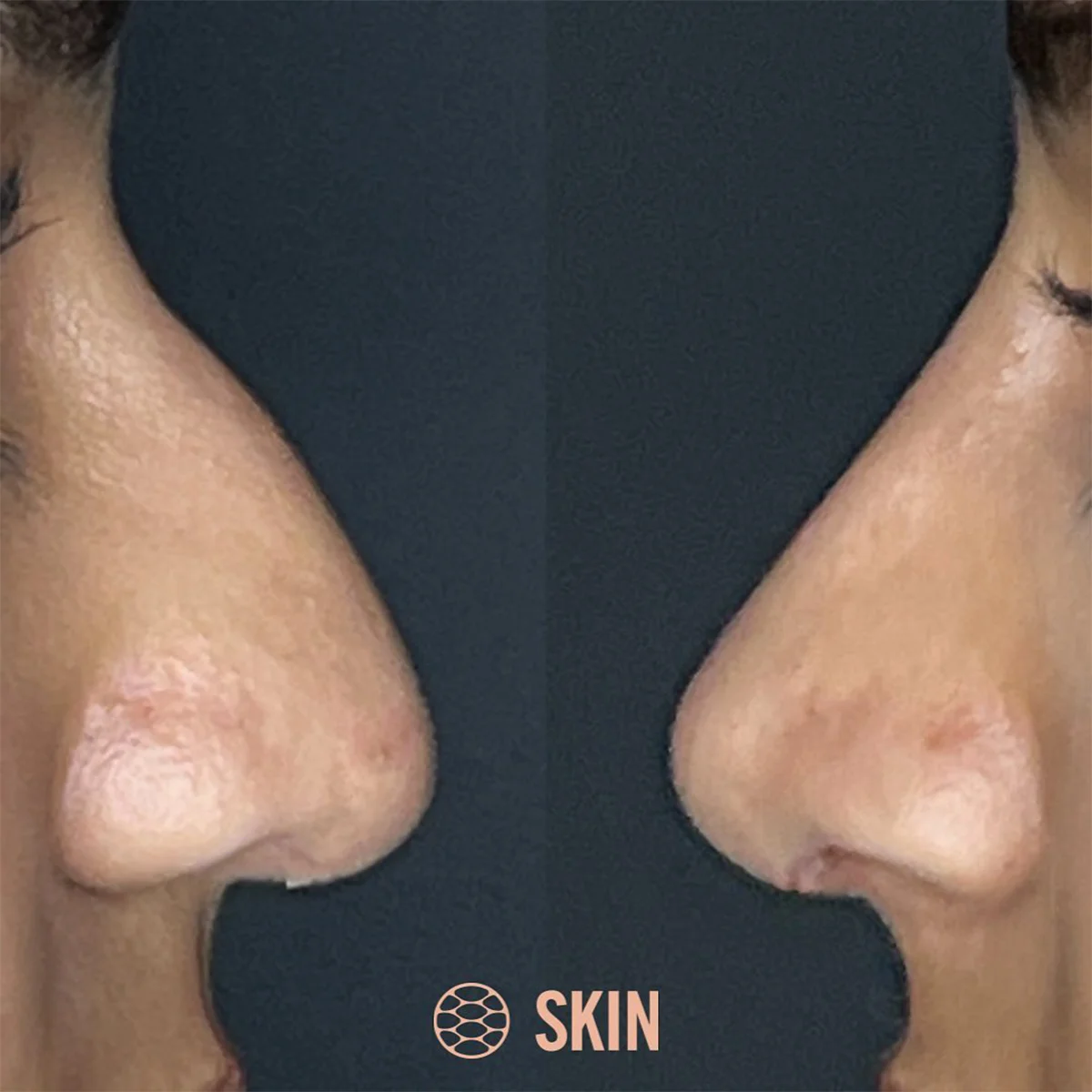 Non Surgical Rhinoplasty calgary 10 SKIN Clinics