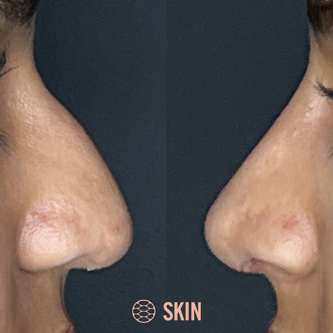 Non Surgical Rhinoplasty calgary SKIN Clinics