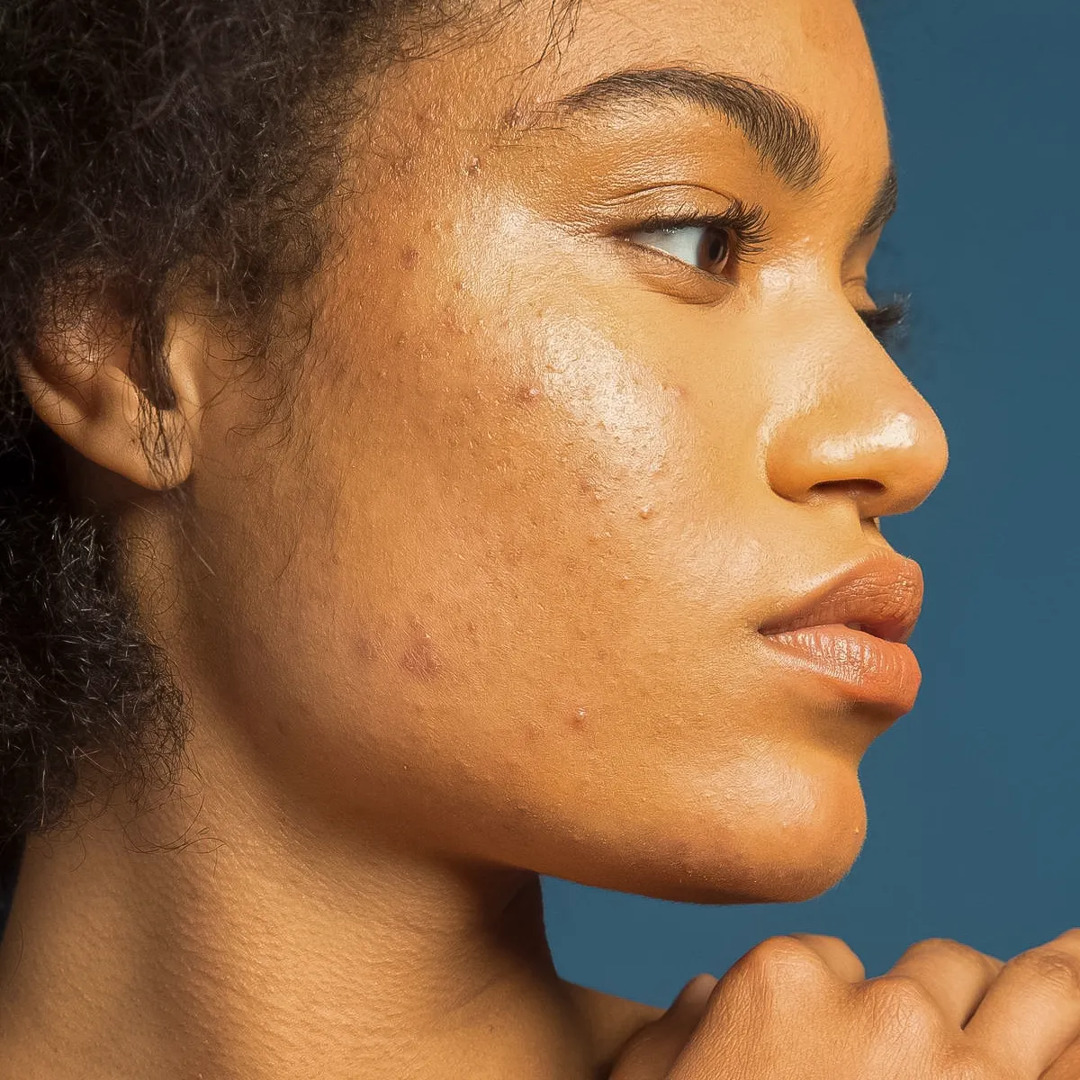 dark skin woman with acne and acne scar.