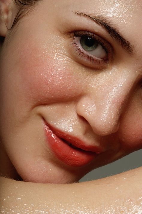 Rosacea 3 SKIN Clinics