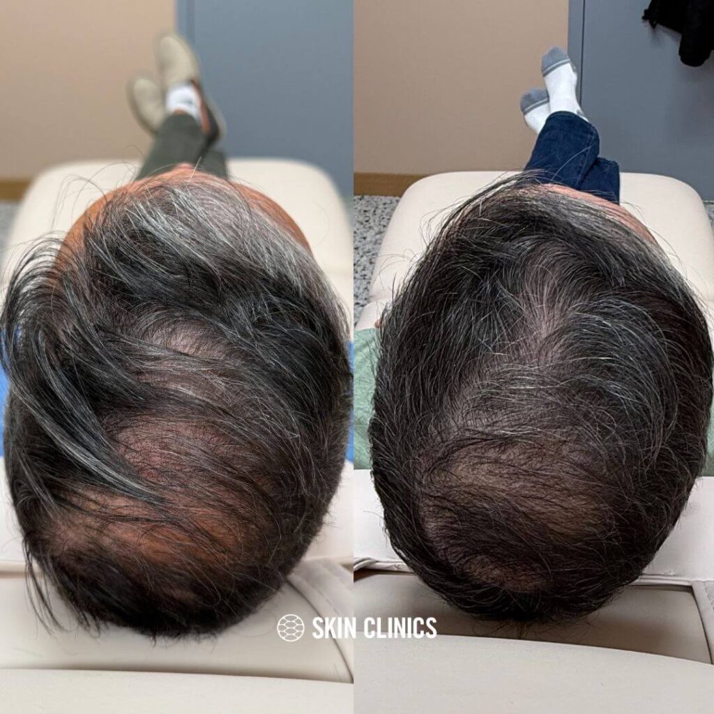 Before and After @skinclinics 1 SKIN Clinics