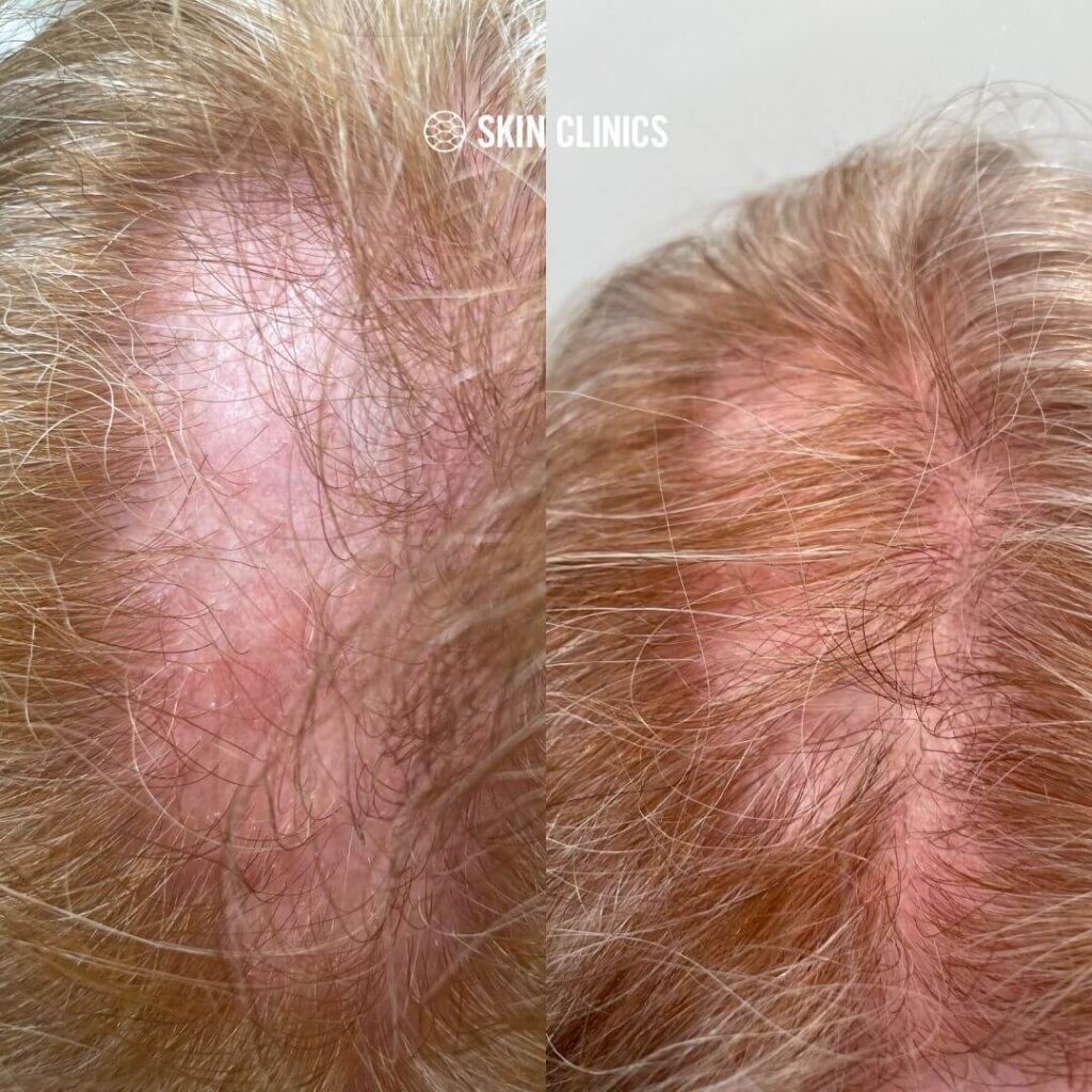 Before and After @skinclinics 2 1 SKIN Clinics