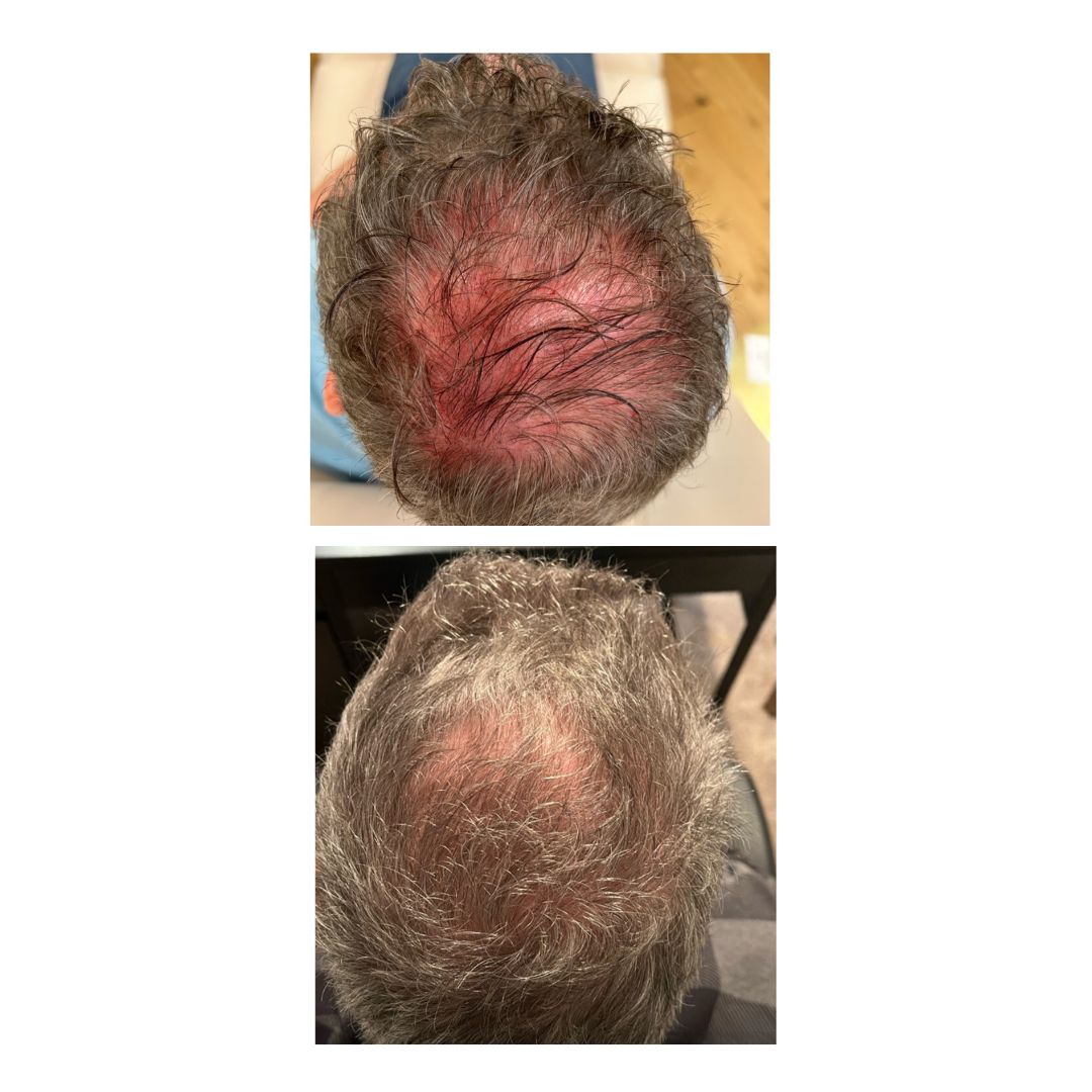 prp scalp SKIN Clinics