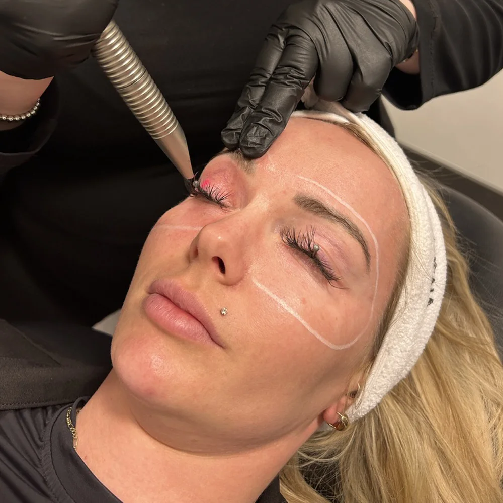 Laser eye renewal SKIN Clinics